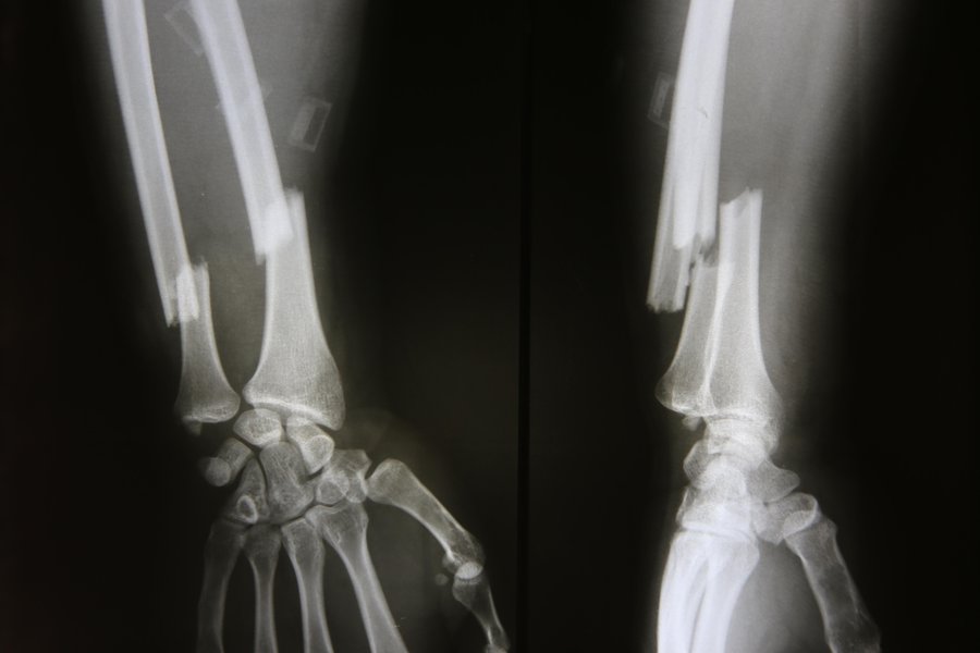 Hueso roto en inglés Traductor de español a inglés